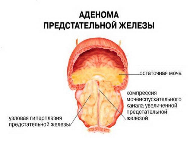 Простагут Форте Prostagutt Forte инструкция по применению