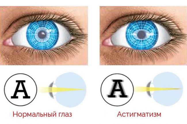 Дальнозоркий астигматизм и близорукость: что это такое