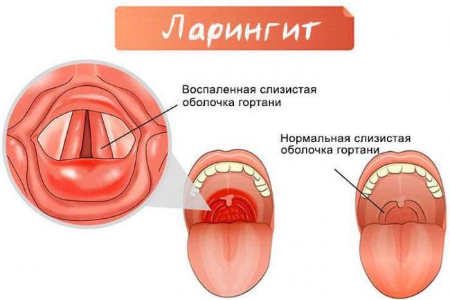 Воспаление гортани: симптомы и лечение. какая нужна диагностика?