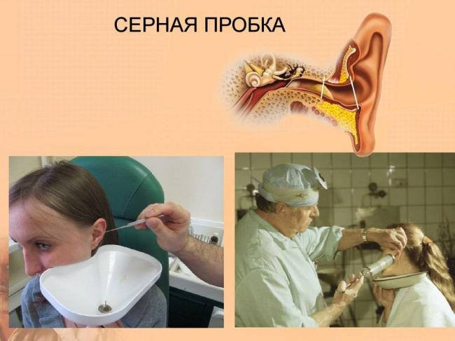 Серные пробки в ушах, как удалить самостоятельно?