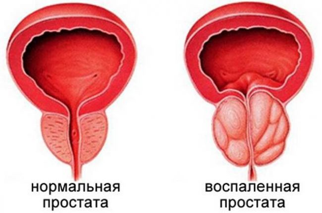 Когда применяются уколы лонгидаза