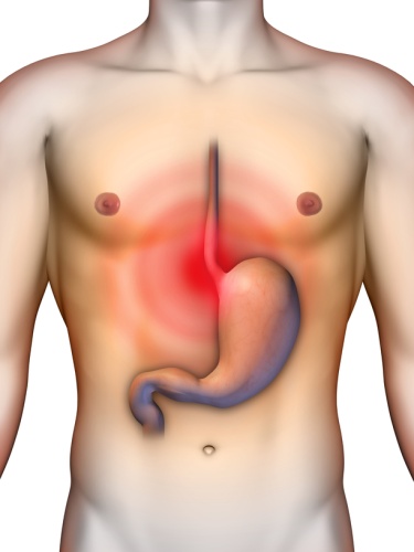 Гастроэзофагеальная рефлюксная болезнь - gastroesophageal reflux disease - qwe.wiki
