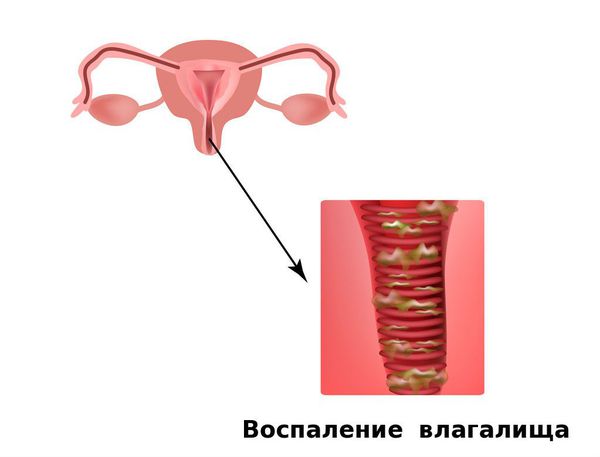 Неспецифический кольпит: что это и как его лечить?