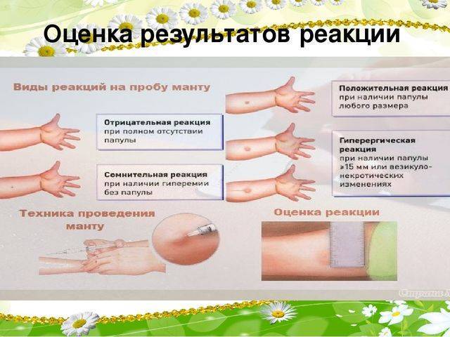 Что делать если у ребенка положительная реакция манту и как выглядит плохая проба