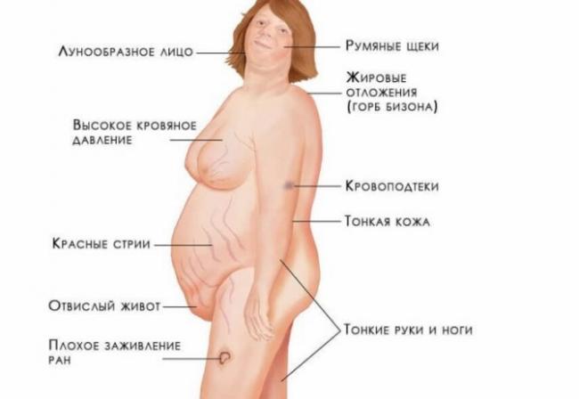 Синдром и болезнь иценко-кушинга (гиперкортицизм)