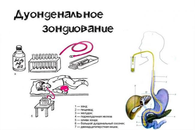 Хронический холецистит