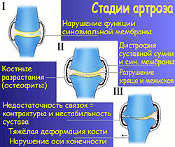 Диета при остеоартрозе коленного сустава 2 степени лечение