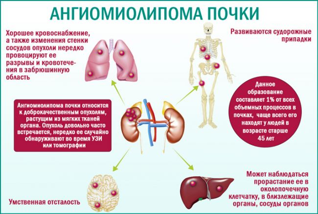 Ангиолипома почки: симптоматика заболевания и его диагностика