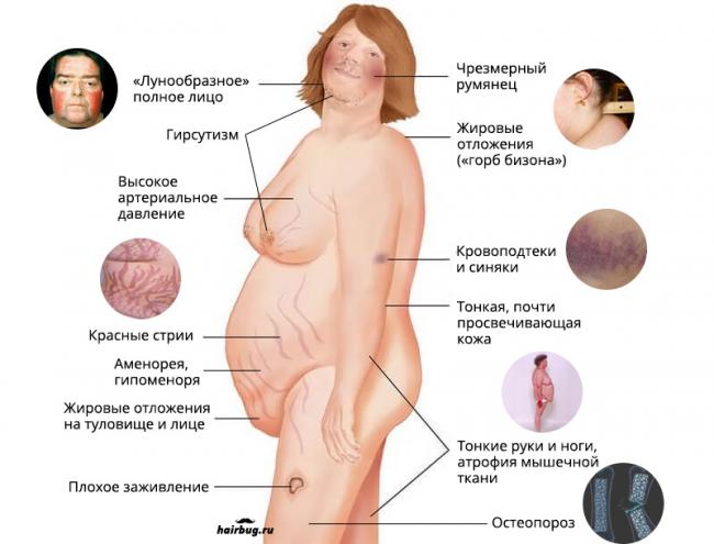 Синдром иценко-кушинга – самые эффективные способы борьбы с недугом