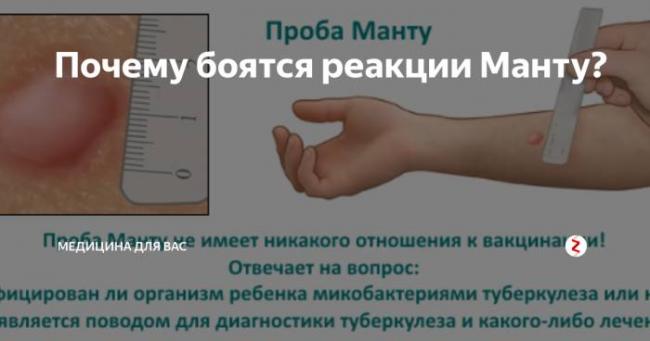 Комаровский - проба манту: увеличенный размер, реакция манту у ребенка, сравнение с диаскинтестом