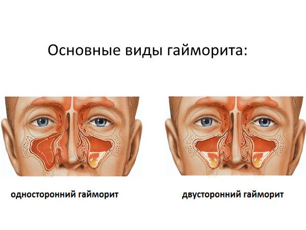 Последствия прокола гайморовых пазух - как избежать осложнений