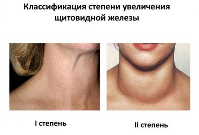 Причины, симптомы, степени и лечение увеличения щитовидной железы