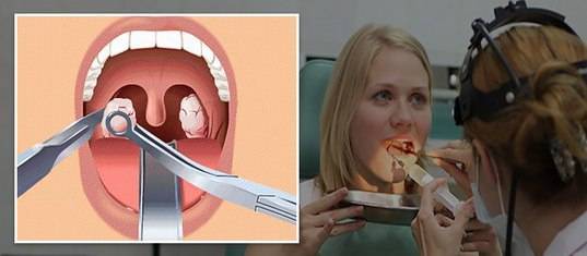 3 схемы лечения лакунарной ангины, симптомы