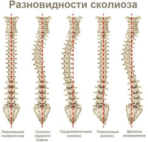 Левосторонний сколиоз