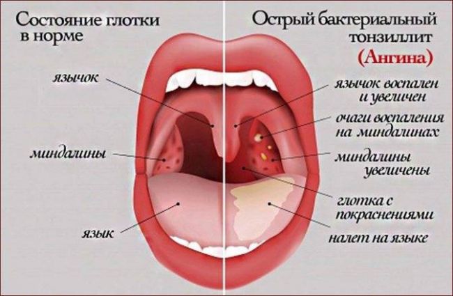 Болезни горла.ларингит.