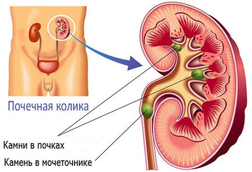 Самые эффективные народные средства для лечения почек