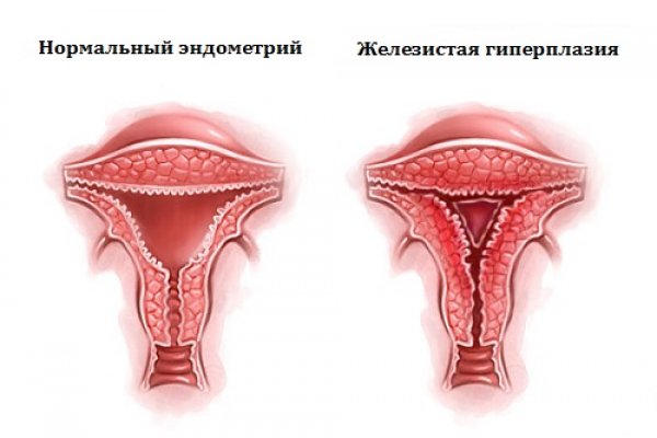 Признаки, симптомы и лечение гиперпластического процесса эндометрия