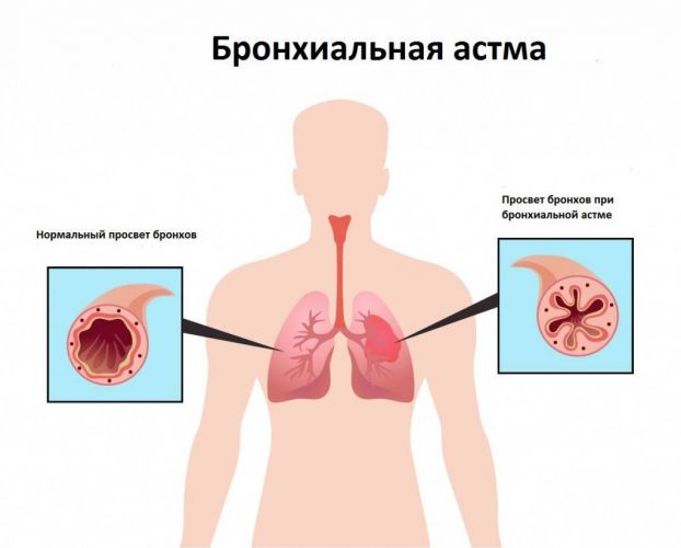 Боль в грудине посередине и кашель сухой чем лечить