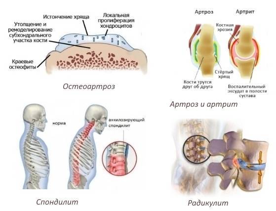 Мелоксикам уколы инструкция по применению