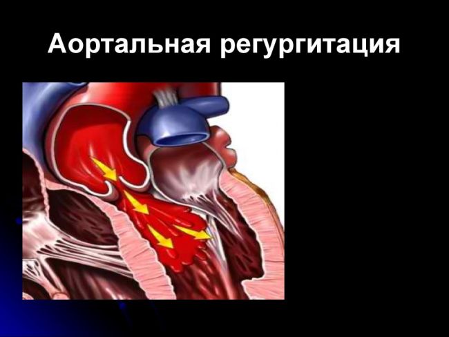 Понятие о регургитации клапана и особенности течения каждой формы