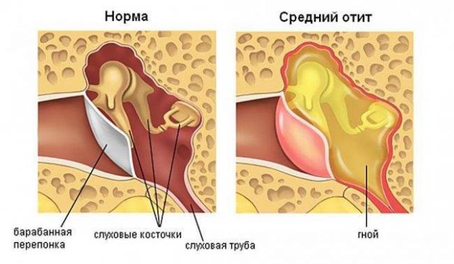 Антибиотики при отите у детей: можно ли вылечить ушными каплями лор заболевания