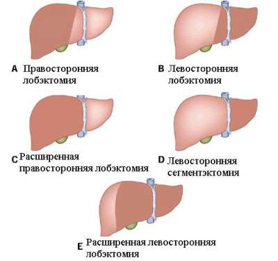 Лечение гемангиомы печени