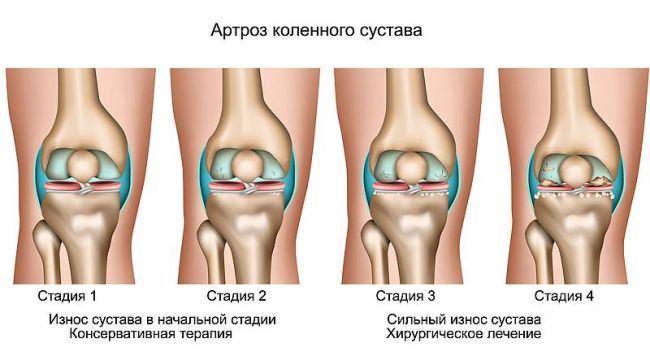 Как продлить срок службы эндопротеза тазобедренного сустава: советы и статистика износа