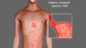 Гастроэзофагеальная рефлюксная болезнь (гэрб)