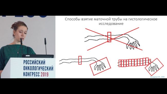 Тубулярная аденома толстой кишки