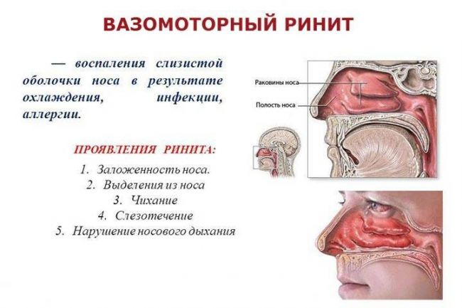 Вазомоторный ринит (насморк) у взрослых: причины возникновения, симптомы и способы лечения
