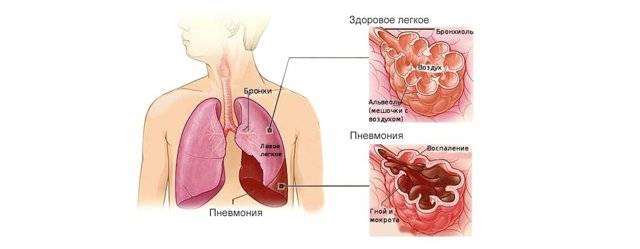 Опасна ли застойная пневмония у лежачих? как её предотвратить?