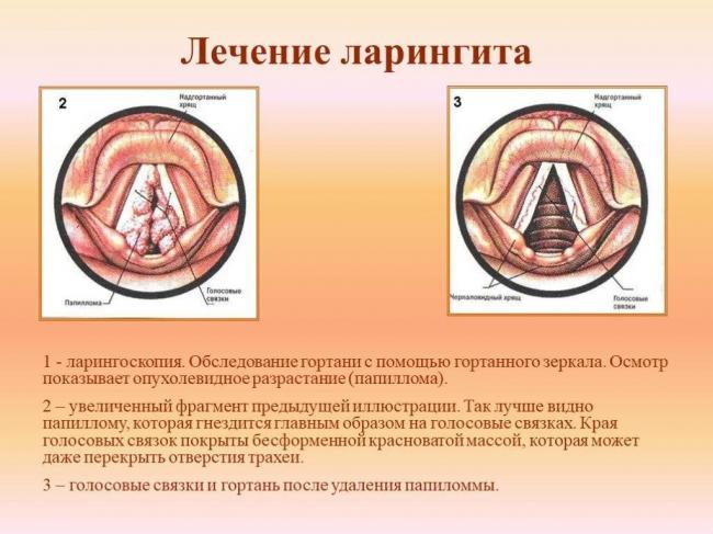 Эффективные лекарства от ларингита: антибиотики, симптоматические, средства для местного применения