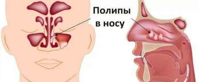 После простуды нос не дышит что делать