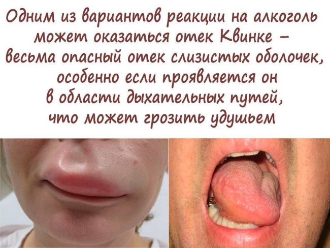 Аллергия на алкоголь: симптомы у взрослых и как избавиться от аллергии на пиво, вино, водку и другие напитки