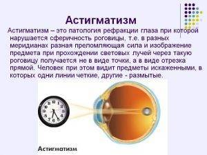 Астигматизм у детей