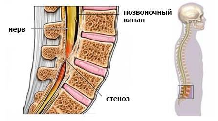 Сколько дней температура при остеохондрозе?