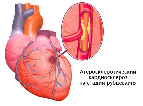 причины, признаки, симптомы и лечение