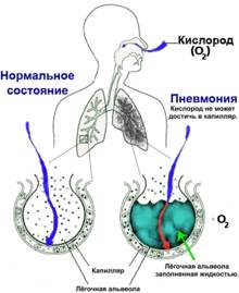 Пневмония без температуры