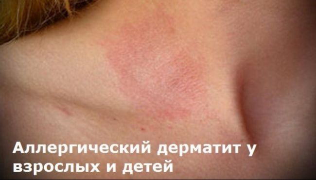 Аллергический дерматит: симптомы и лечение аллергического дерматита у детей и взрослых