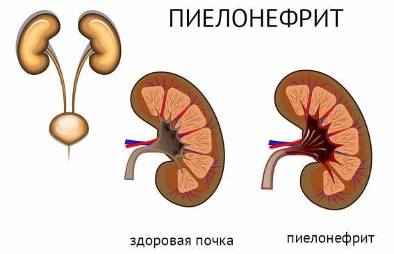 Сморщенная почка: как определить болезнь по симптомам и что делать при ее лечении?