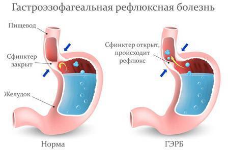 Чувство жжения в горле, что делать если печет и горит изнутри