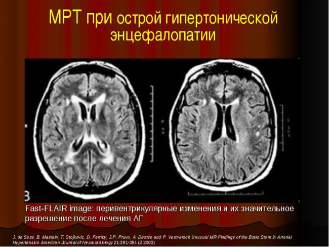 Энцефалопатия