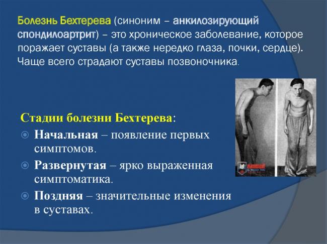 Болезнь бехтерева — википедия с видео // wiki 2