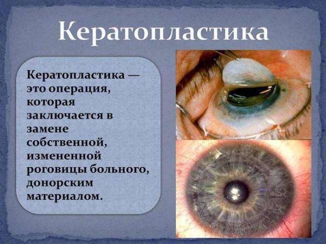 Бельмо на глазу у человека