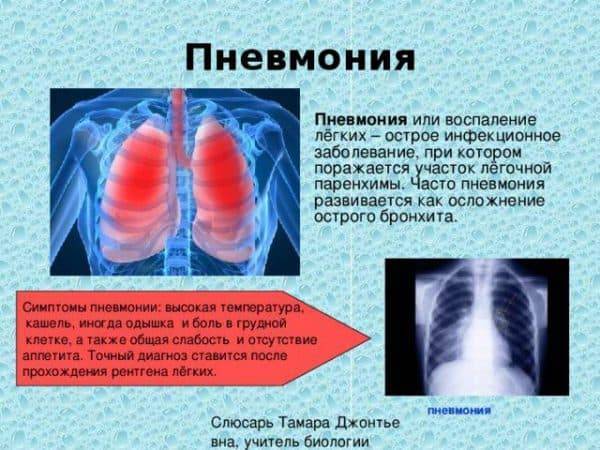Первые признаки воспаления легких