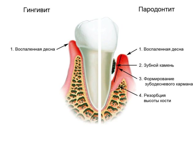 Пародонтоз и пародонтит