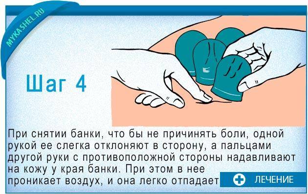 Банки на позвоночник: противопоказания