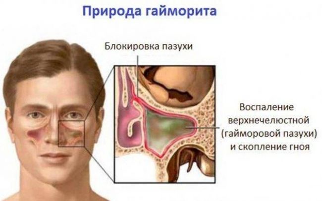 Можно ли вылечить гайморит, не прибегая к проколу?
