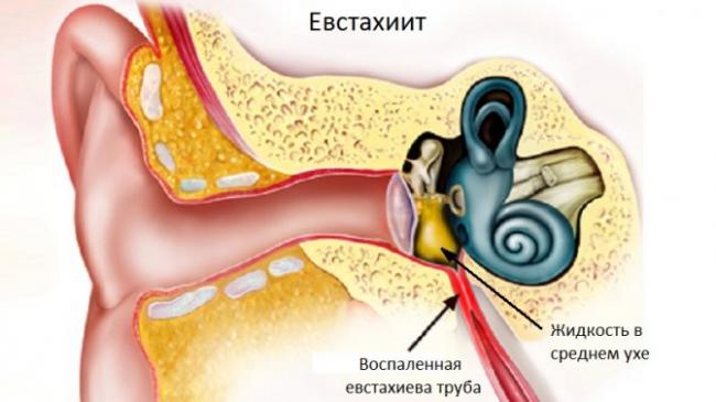 Нейросенсорная потеря слуха двусторонняя: причины развития, симптоматика, диагностика, лечение и профилактика
