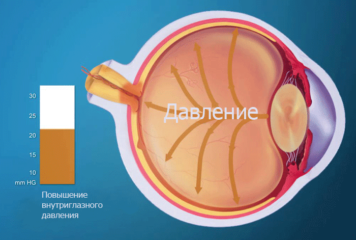 Повышенное внутриглазное давление симптомы у взрослых